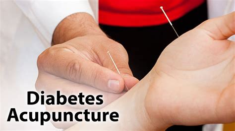 Acupuncture For Diabetes Body N Soul Part 2 Youtube