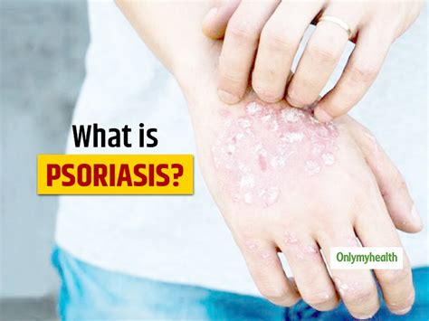 Psoriasis System Disorder Template