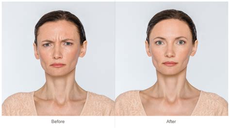 Botox® Vs Facelift An Explanation Of These Two Very Different