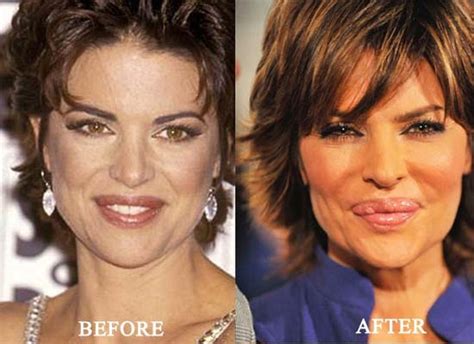 Lisa Rinna Before And After Lip Implants Surgery