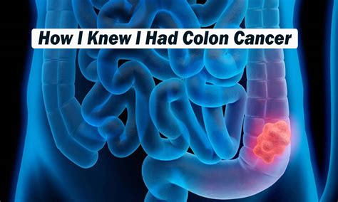 How I Knew I Had Colon Cancer Healthteps