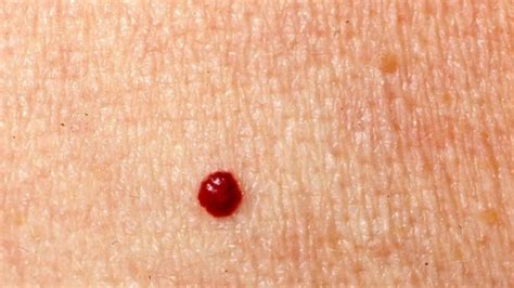 Remove Cherry Angioma At Home For Free Easy Medical Life Hack