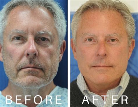 Mens Facelift Before And After Before And After