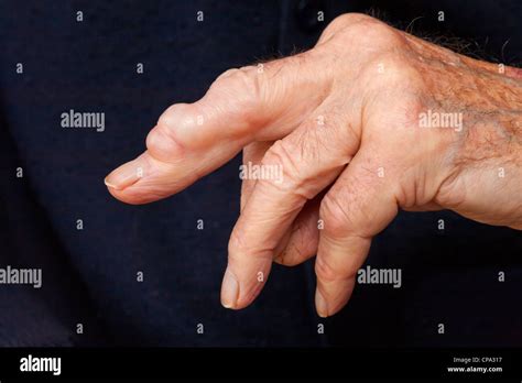 Ganglion Cyst Hi Res Stock Photography And Images Alamy