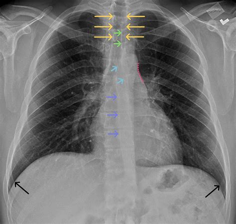 Radiographic Anatomy Of Chest X Ray Drop The Daily Chest X Rays For