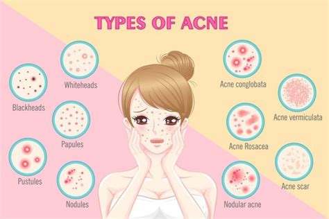 Acne Rosacea Pimples Oily Skin Care Acne Prone Skin Papules Acne