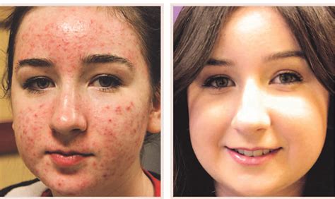 About Laser Acne Treatment Simply H Healthy Solutions