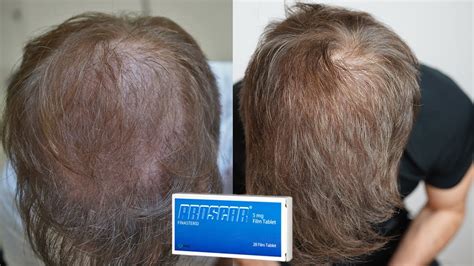 Finasteride For Hair Loss In Women Topical Finasteride Incredible Results For Male Hair Loss