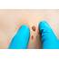 What Skin Tags Are—and How To Get Rid Of Them  University Health News