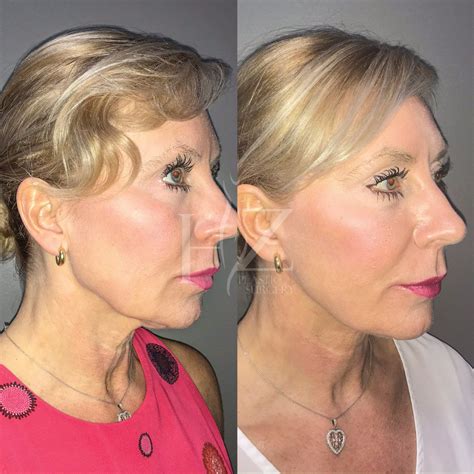 Face Lift Before And After Hz Plastic Surgery In 2021 Facelift Face Lift Surgery Lower Face Lift