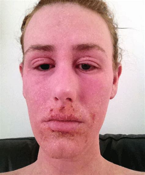 Woman Left With Red Raw Skin Due To Extreme Skin Uk
