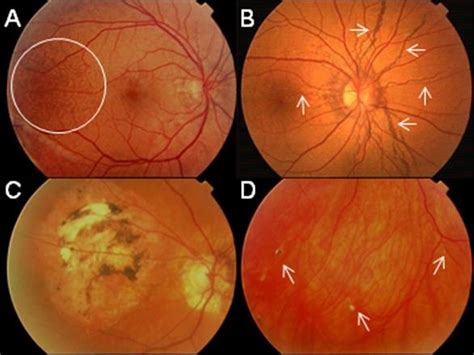Pxe Retinopathy Features With Peau Dorange A Circle Angioid