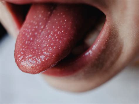 Is A Scalloped Tongue Serious