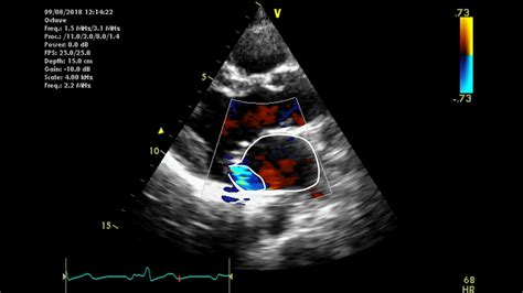 Normal Mitral Valve Cross Section On Echocardiography