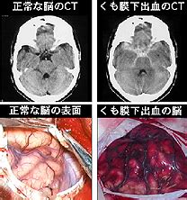 Axial slice of mri with all anatomical structures labeled. 50+ 脳出血 くも膜下出血 Ct - カゼザナモ