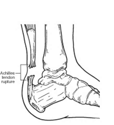 Tendon tissue is also known as sinew. Achilles Tendon Rupture - Foot Health Facts