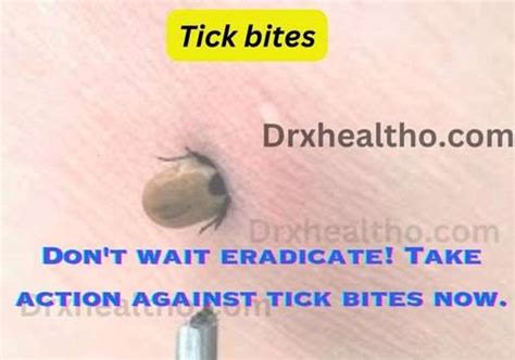 Tick Bites Symptoms Treatment Pictures And Prevention