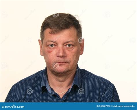 Close Up Portrait Of A 50 Year Old Man With A Swollen Cheek And A Black