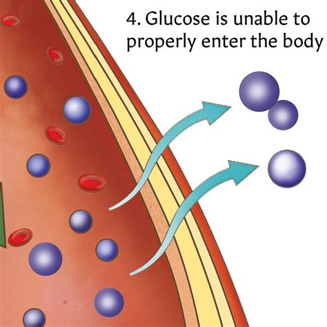 The Anatomy Of Type 1 Diabetes Chartposter Laminated Endocrine