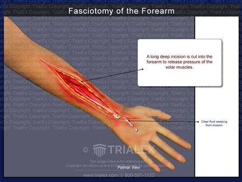 Fasciotomy Of The Forearm Trial Exhibits Inc