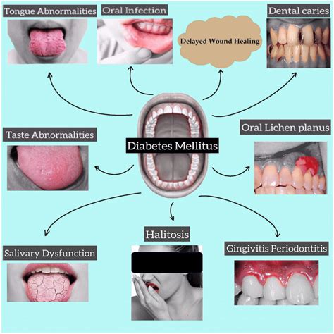Complications Of Oral Cavity In Diabetes Mellitus Download Scientific Diagram