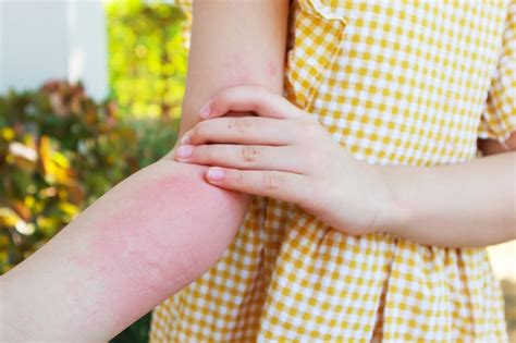 Protect Your Child 8 Common Rashes And Skin Problems Explained