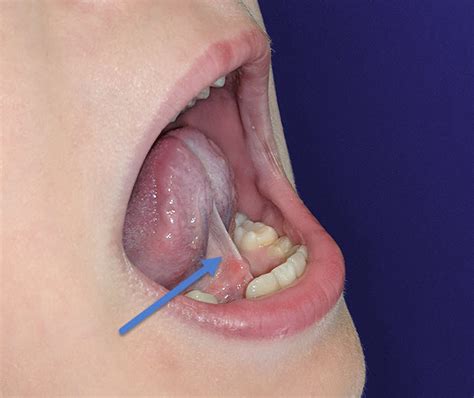 Ankyloglossia Tongue Tie The Dental Arcade Blog