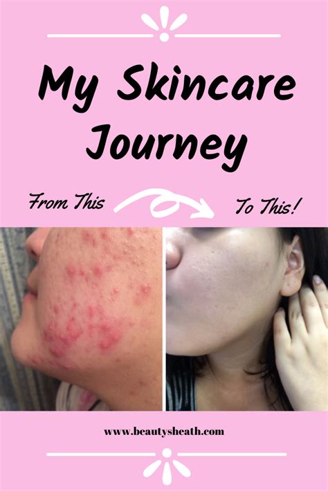 How I Went From Painful Cystic Acne To Clear Skin Painful Acne