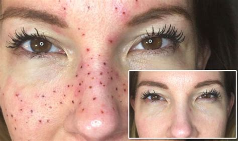 Fake Freckles Beauty Trend Sees Young Girls Tattoo Their Face Express
