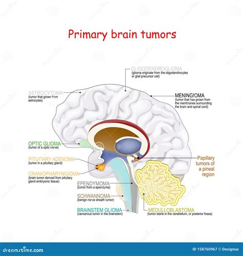 Brain Cancer Different Types Of Primary Brain Tumors Stock Vector