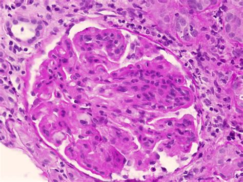 Pathology Outlines Systemic Lupus Erythematosus