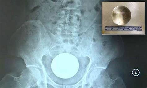 Chinese Man Has A In Wide Glass Ball Stuck In His Rectum Daily Mail Online