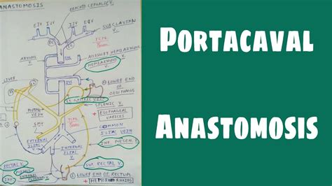 Portacaval Anastomosis Part 2 The Charsi Of Medical Literature