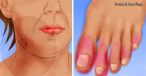 13 Early Warning Signs Of Lupus You Need To Know And What To Do The