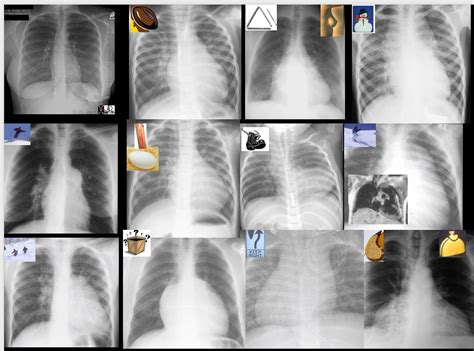 Frontal Chest X Ray And The Heart Cxr Heart
