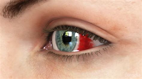 Subconjunctival Hemorrhage First Eye Care Irving