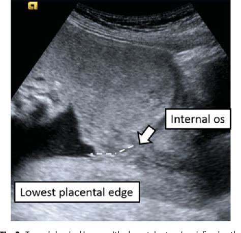 With the former, your entire cervix is covered; Figure 2 from Complete Placenta Previa: Ultrasound ...
