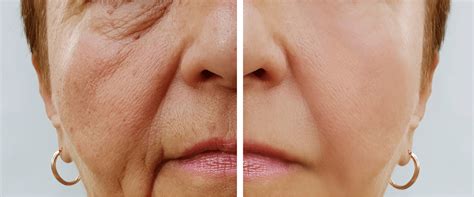 Face Wrinkles Modern Body Clinic