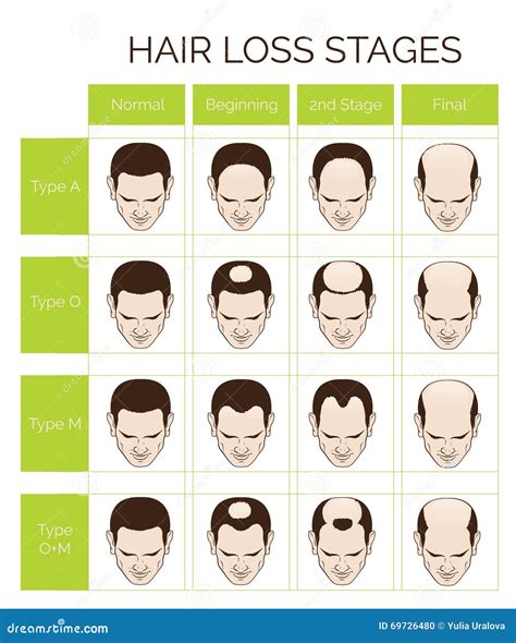 Hair Loss Stages Vector Isolated Male Alopecia Set Of Balding Process