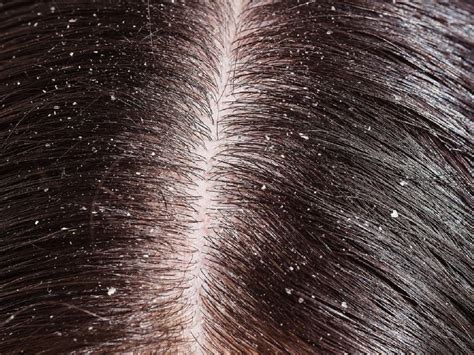 Details More Than 75 Flakes In Hair Ineteachers
