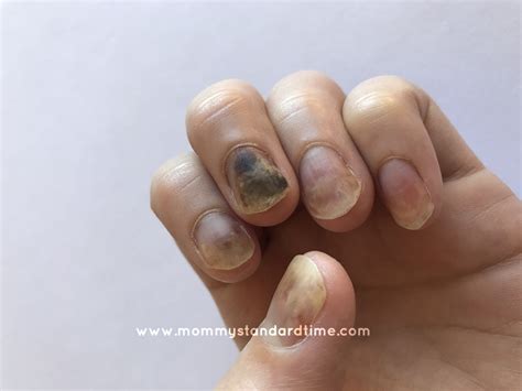 Fingernails Damaged By Chemo Mommy Standard Time