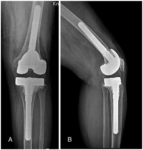 Revision Total Knee Arthroplasty Using A Constrained Condylar Knee