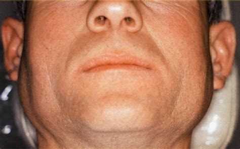 Figure 1 From Sialosis 35 Cases Of Persistent Parotid Swelling From