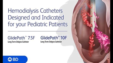 bd glidepath™ 7 5f and 10f long term hemodialysis catheter procedural animation no audio youtube