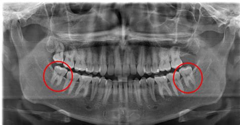 Wisdom Teeth Real Pictures And Facts Web Dmd