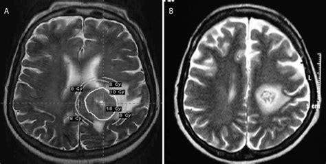 Axial T2 Weighted Brain Mri Scan Shows A Solitary Metastatic Lesion In