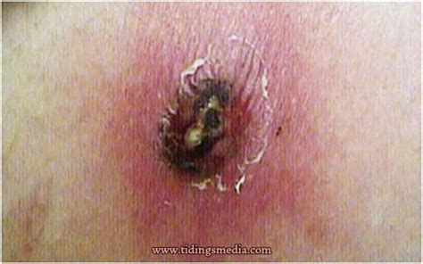 Brown Recluse Spider Bite Pictures Stages Symptoms Treatment And Home