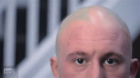 Denis Has Alopecia Areata Treatment At His Hair Clinic Youtube