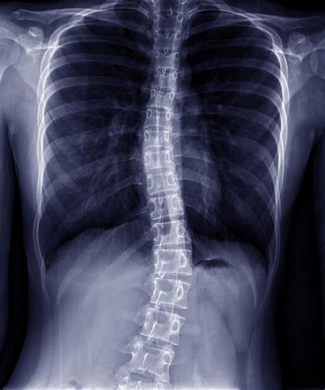 Scoliosis Surgery And Care In Nj And Ny Igea Brain Spine And Orthopedics
