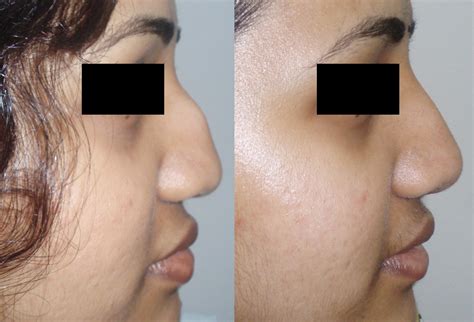 The contour would actually make the crookedness stand out more. Rhinoplasty (Nose Job) in Hyderabad & India|Nosecontour.com